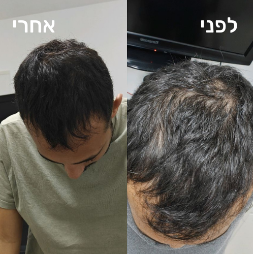 רולר לצמיחת שיער הראש – תמונה 2