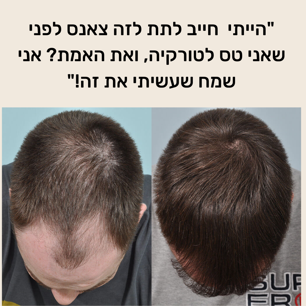 רולר לצמיחת שיער הראש